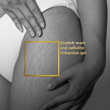 VLCC Clinic Anti-Stretch Mark Cream - 100ml | Cellulite & Stretch Mark Reduction Cream | Easy Absorption | Helps Fade Stretch Marks and Brighten Skin | Dermatologically Tested